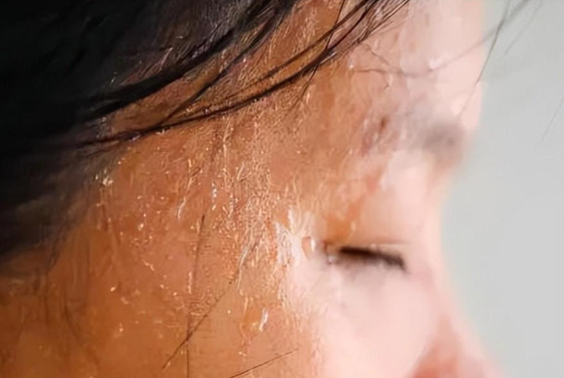 头脖子爱出汗中医认为是什么原因,头部容易出汗中医认为是什么原因