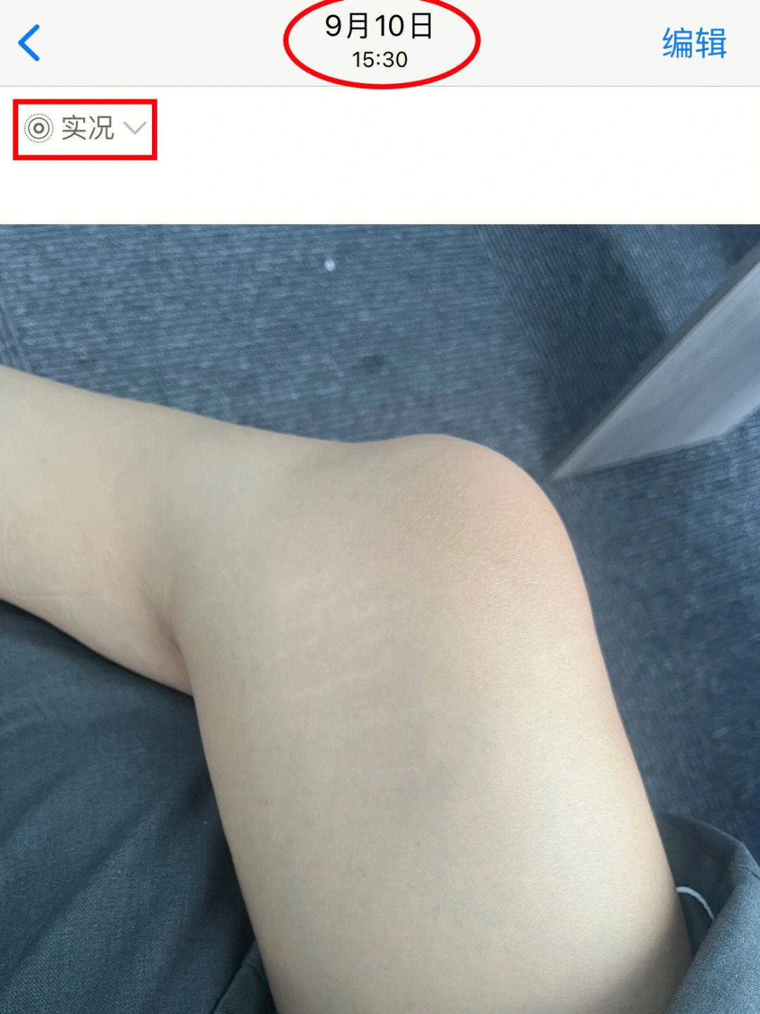 胳膊和大腿上的肥胖纹怎么能消掉,大腿有肥胖纹有十年了还能去掉吗