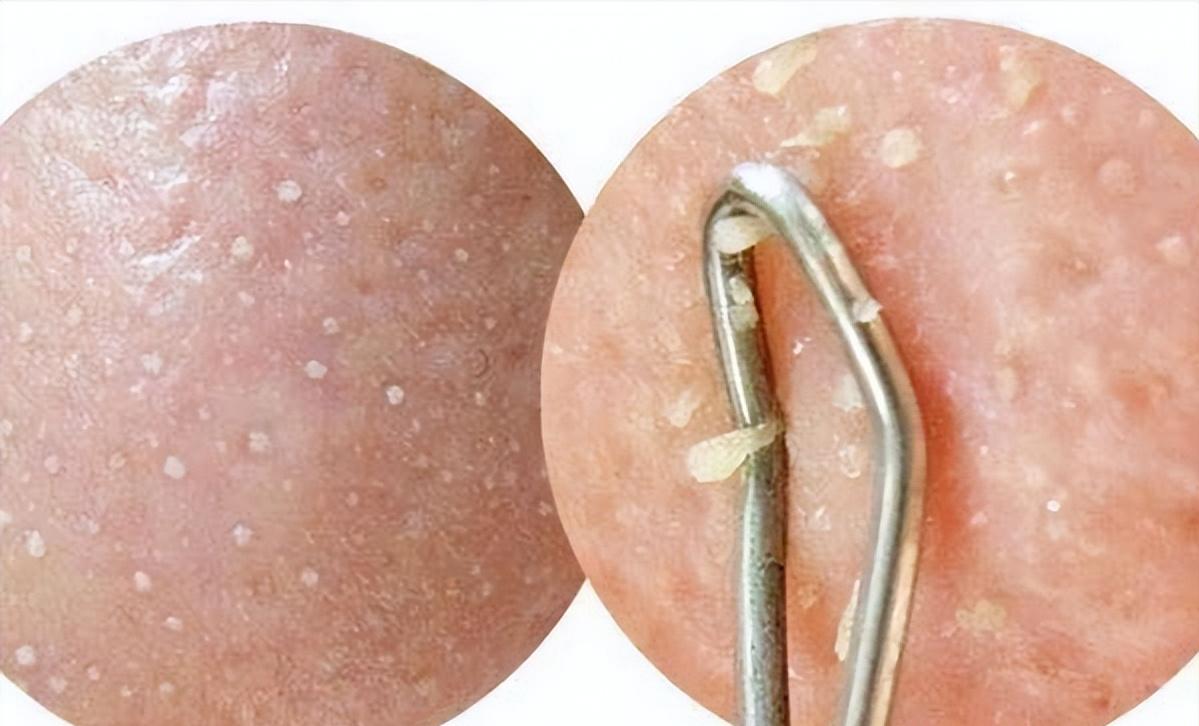 鼻子的黑头跟草莓一样,草莓黑头怎么去除最有效