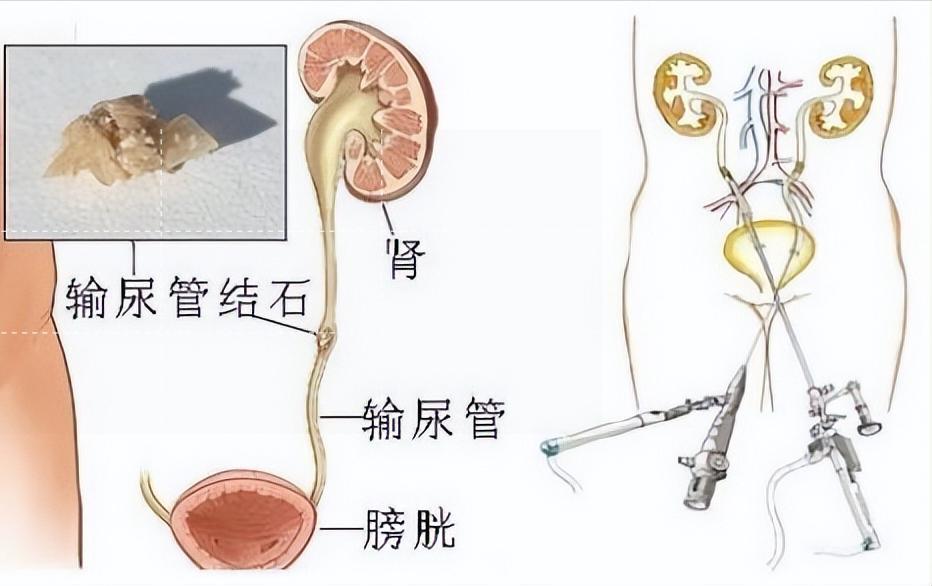 上尿路上皮癌根治性切除术,输尿管高级别浸润性尿路上皮癌