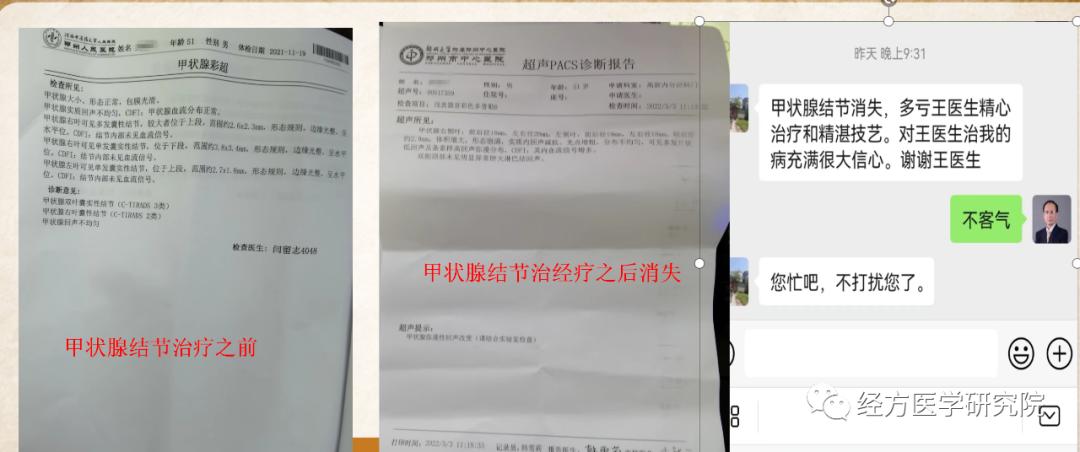 甲状腺结节乳腺增生经方案例,王付教授谈结节