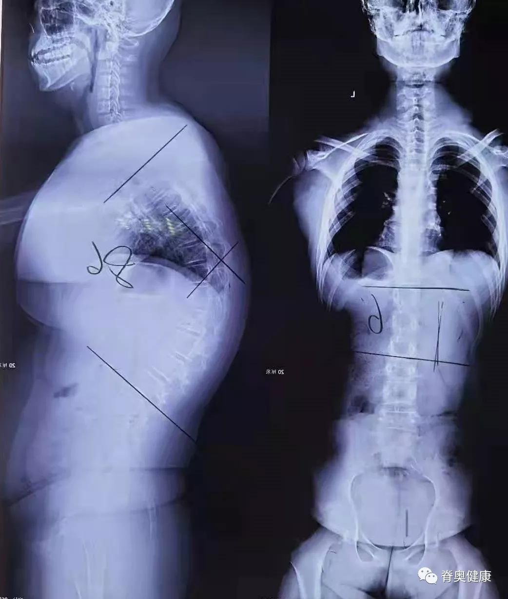 「胸椎后凸」小朋友怎么“老”了，该如何挺直脊梁？