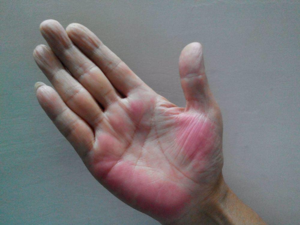 出现蜘蛛痣意味着肝病很严重吗,有蜘蛛痣是肝病的几率有多大