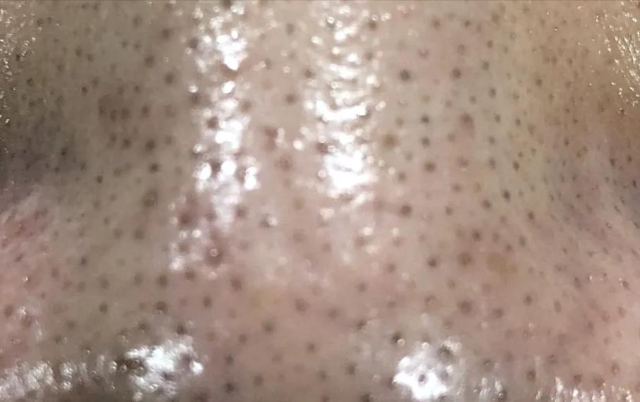 去鼻子上的黑头最好的方法,去鼻子上黑头的有效方法