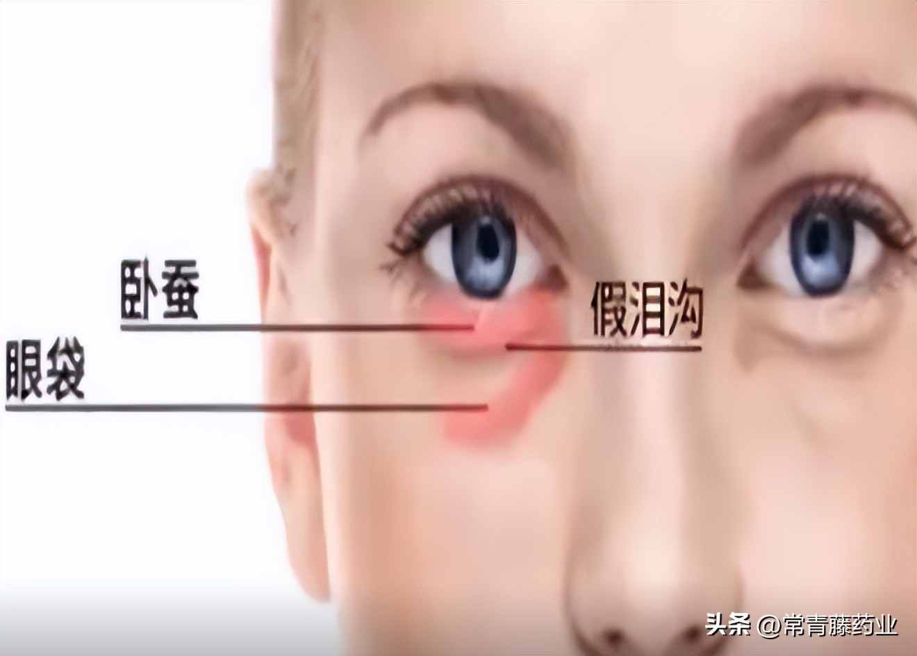 怎样预防缓解泪沟和眼袋,眼袋泪沟的原因及解决方法