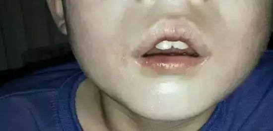 孩子口呼吸矫正贴,儿童嘴呼吸矫正贴有用吗