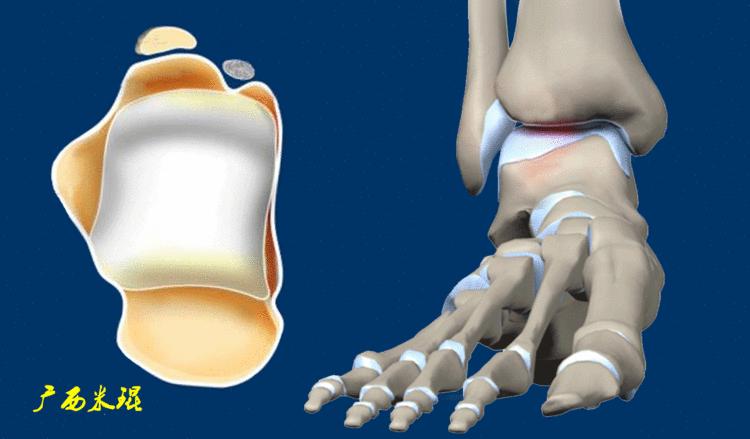 距骨软骨损伤最好的治疗方法,距骨软骨损伤的诊断