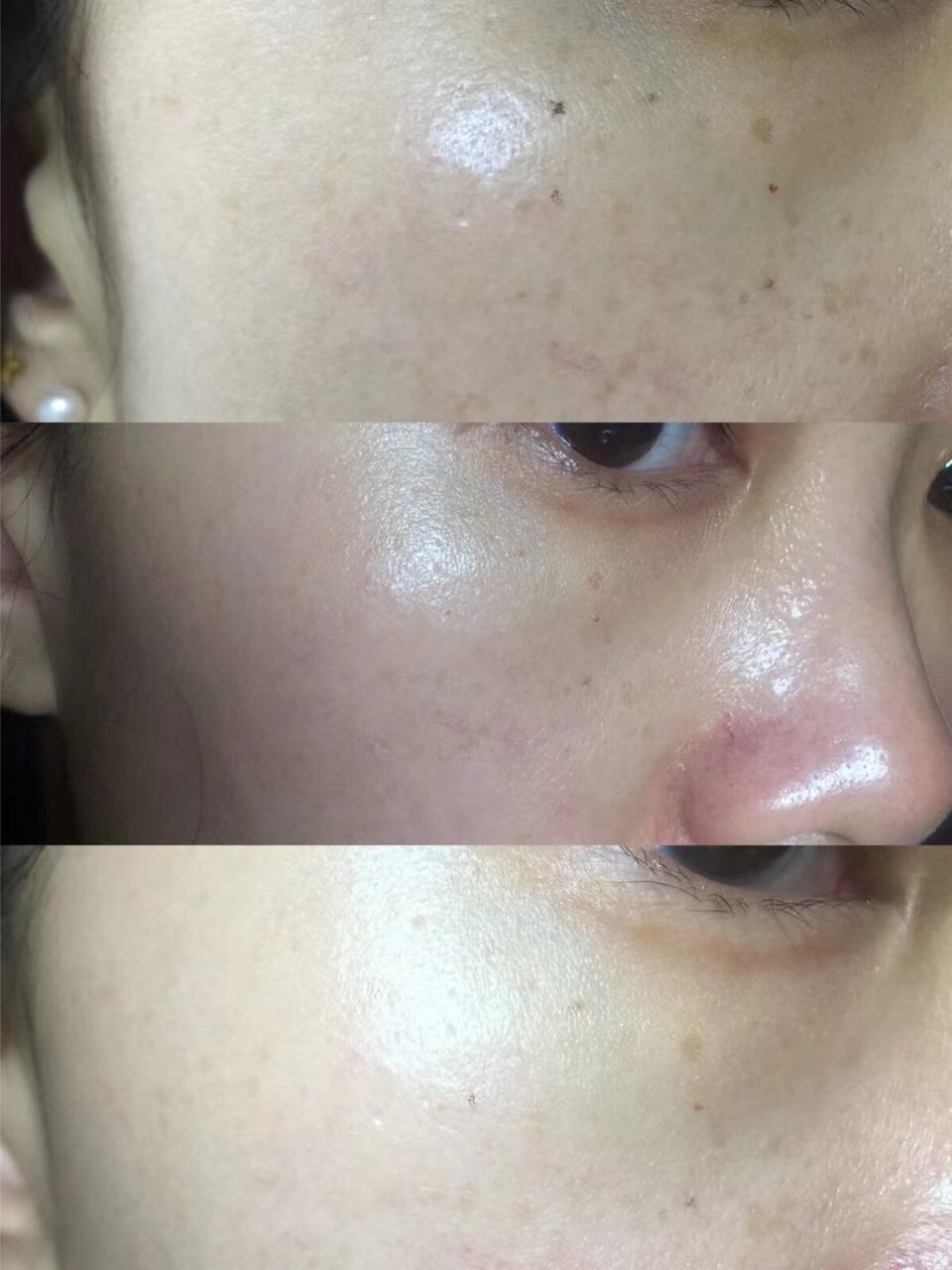 去尝试了一个医美项目光子嫩肤,光子嫩肤的亲身体验