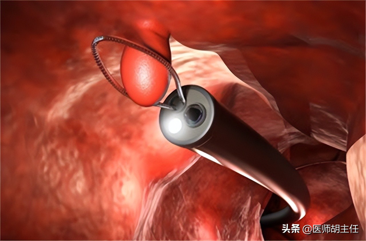 肠道有息肉会出现什么症状,肠道长了息肉有什么症状