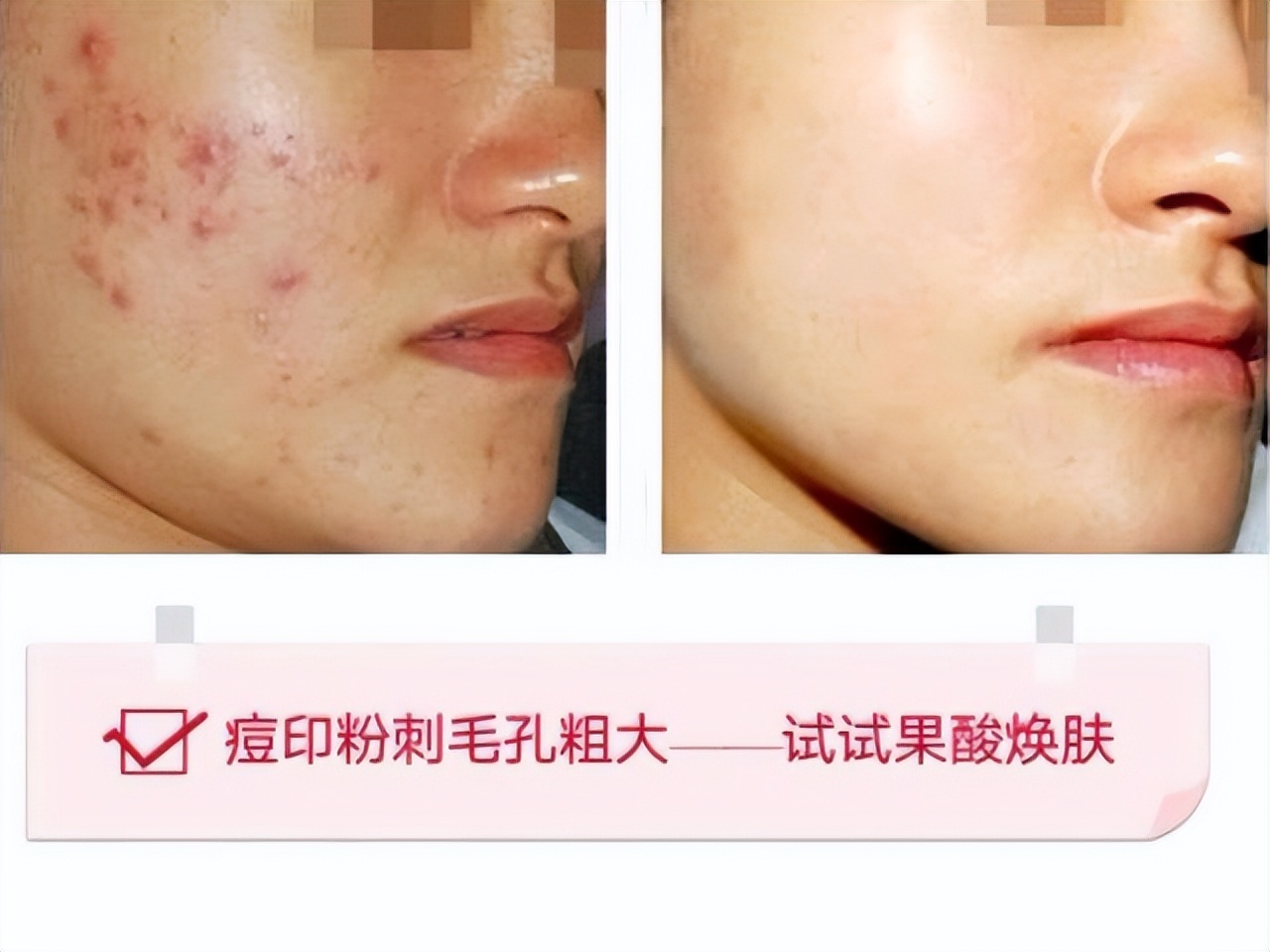 果酸换肤能彻底解决皮肤问题吗,角质薄可以做果酸换肤吗