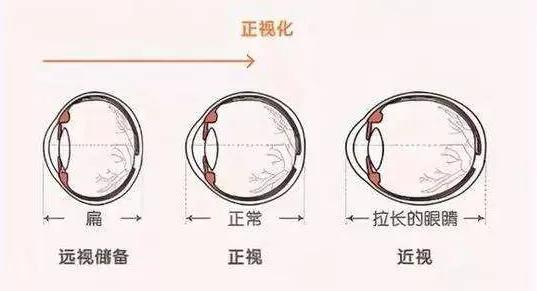角膜塑形镜控制度数的原理是什么,角膜塑形镜控制近视度数增长
