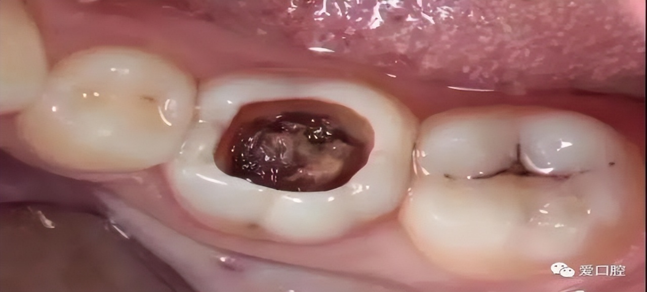 早期龋齿和中期龋齿的区别,科普口腔龋齿图片