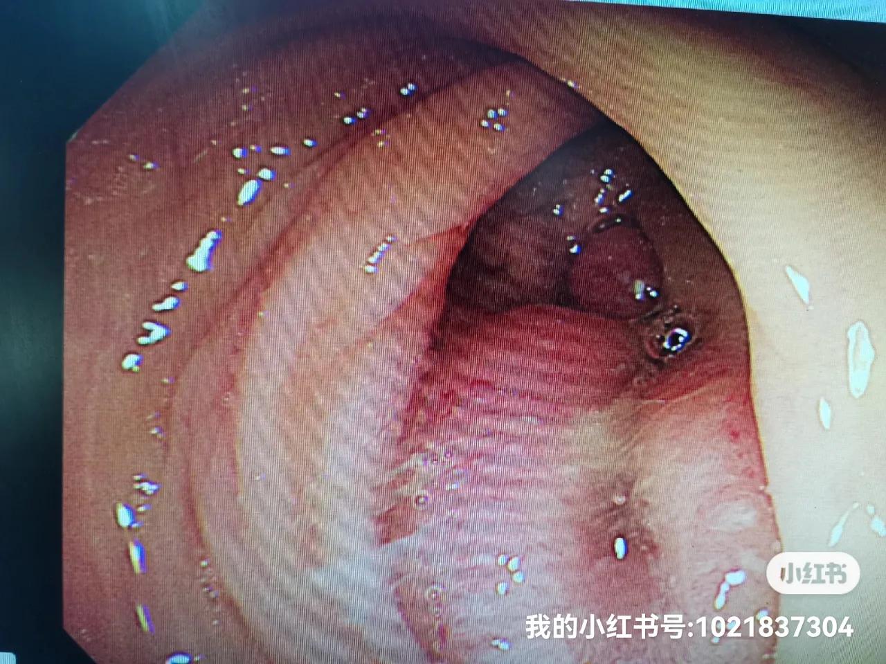 直肠癌肝转移肺,直肠癌肝转移靶向治疗