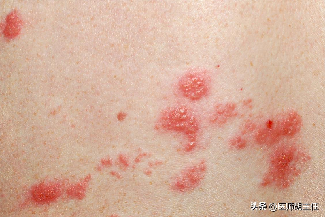 带状疱疹令人疼痛难忍该如何预防,哪些是带状疱疹患者要纠正的误区