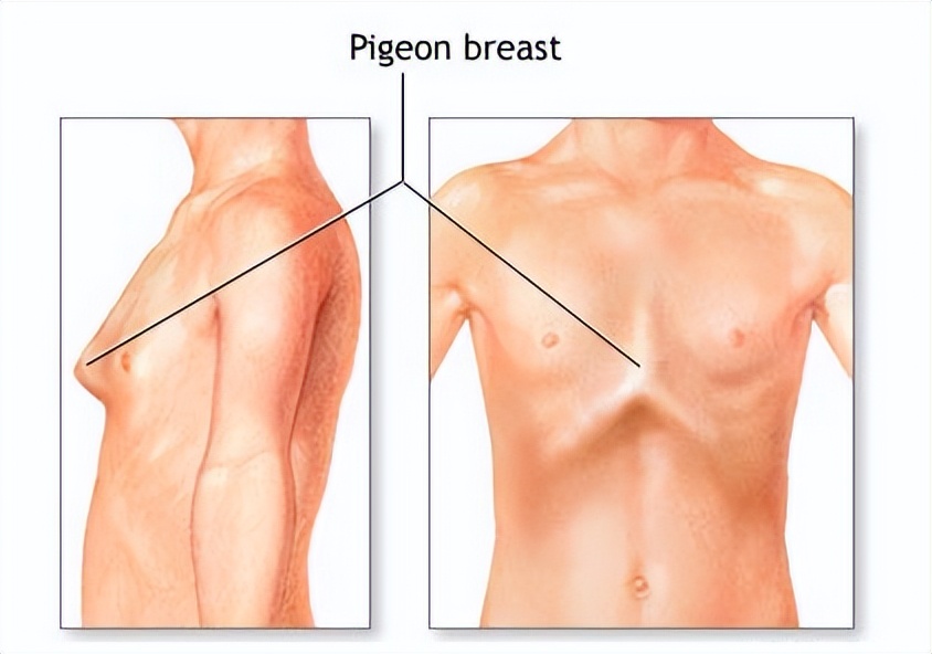 鸡胸不治疗危害大吗,儿童鸡胸的危害与治疗