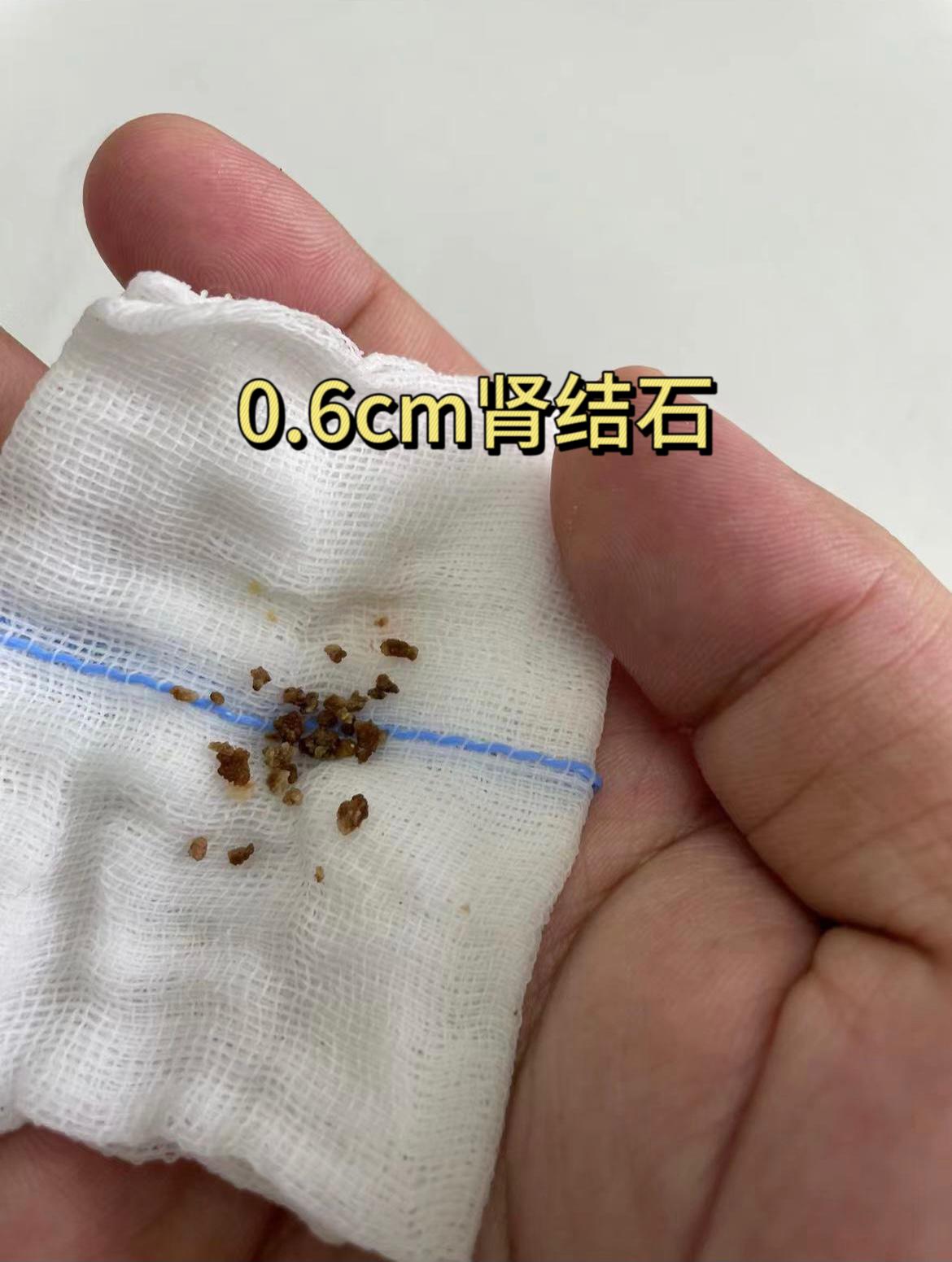 肾结石1.2厘米结石最快的排出方法,0.3-0.5的结石有多大图片