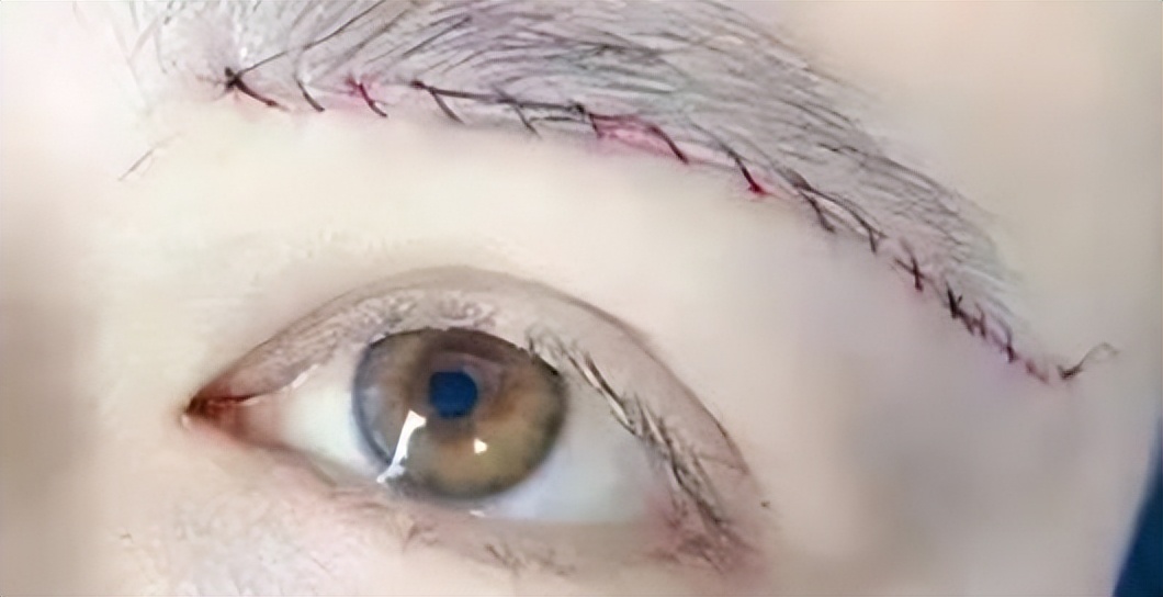 做过提眉术的感觉怎样,做提眉的亲身经历