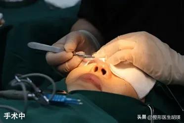 双眼皮术后20天基本不再变化了,挑战双眼皮术后39天做睫毛