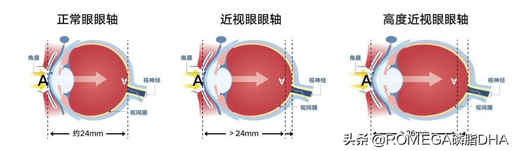 长期戴近视眼镜的眼睛图片,长期戴眼镜眼睛会发生什么变化