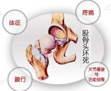 股骨头坏死药方如何辨证加减,治股骨头坏死奇效方