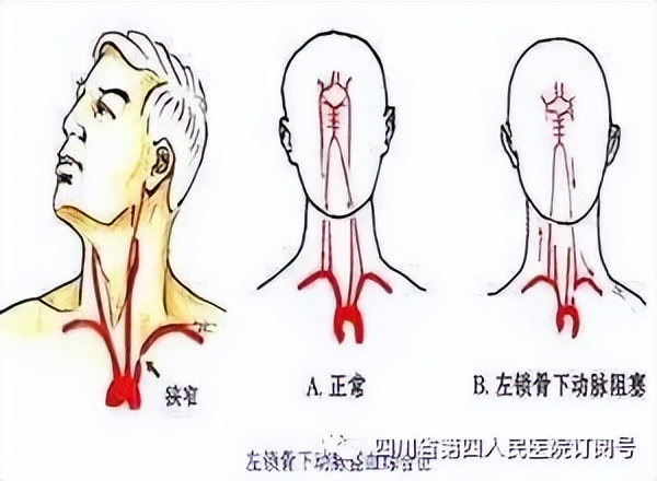 我院首例！左锁骨下动脉支架成形术取得成功，患者已得到改善