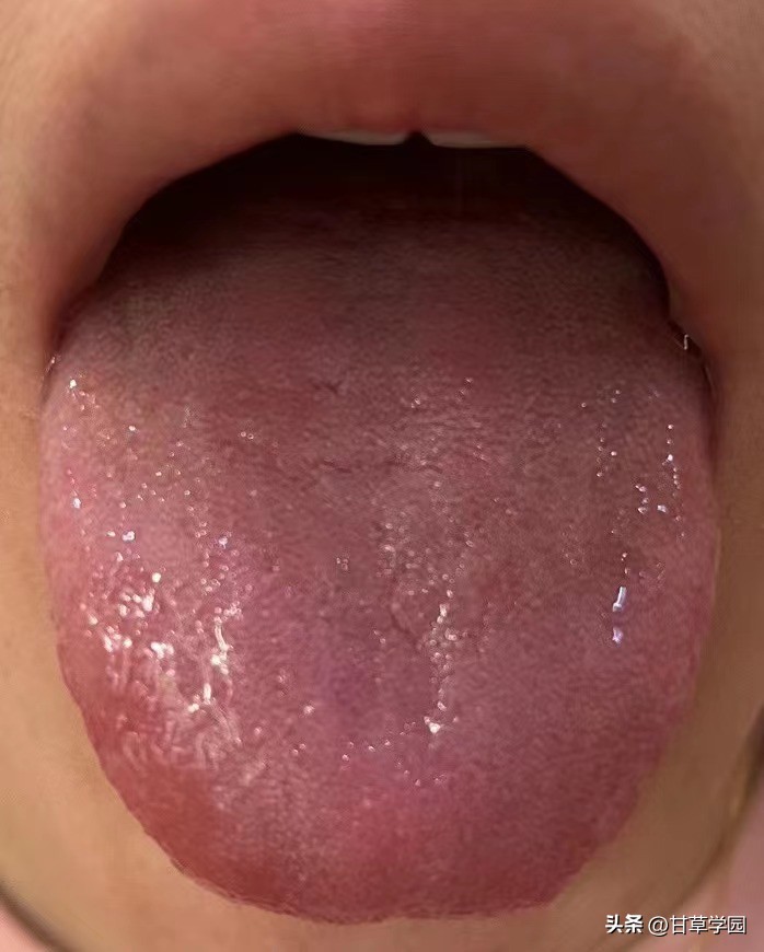 甘草学园|【思考】治疗乙肝、多囊得到明显缓解