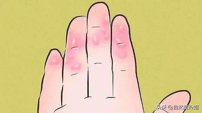 一到夏天手脚长水泡,冬天手脚反复长小水泡很痒怎么治