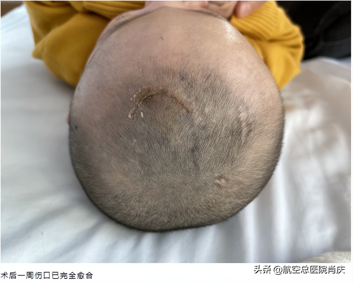 内镜治疗脑积水成功率多大,早产儿脑积水适合神经内镜手术吗