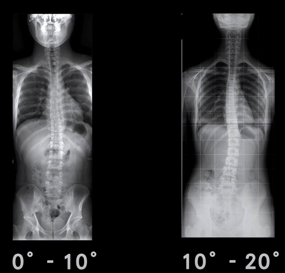 有哪些原因引起脊柱侧弯,有轻微脊柱侧弯怎么办
