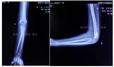 肱骨骨折取钢板怎样恢复,肱骨近端骨折切开复位内固定术