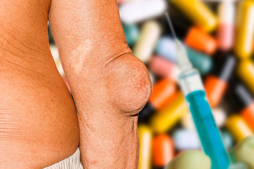 阿仑膦酸钠抗骨质疏松疗效观察,骨折后能不能吃阿仑膦酸钠片