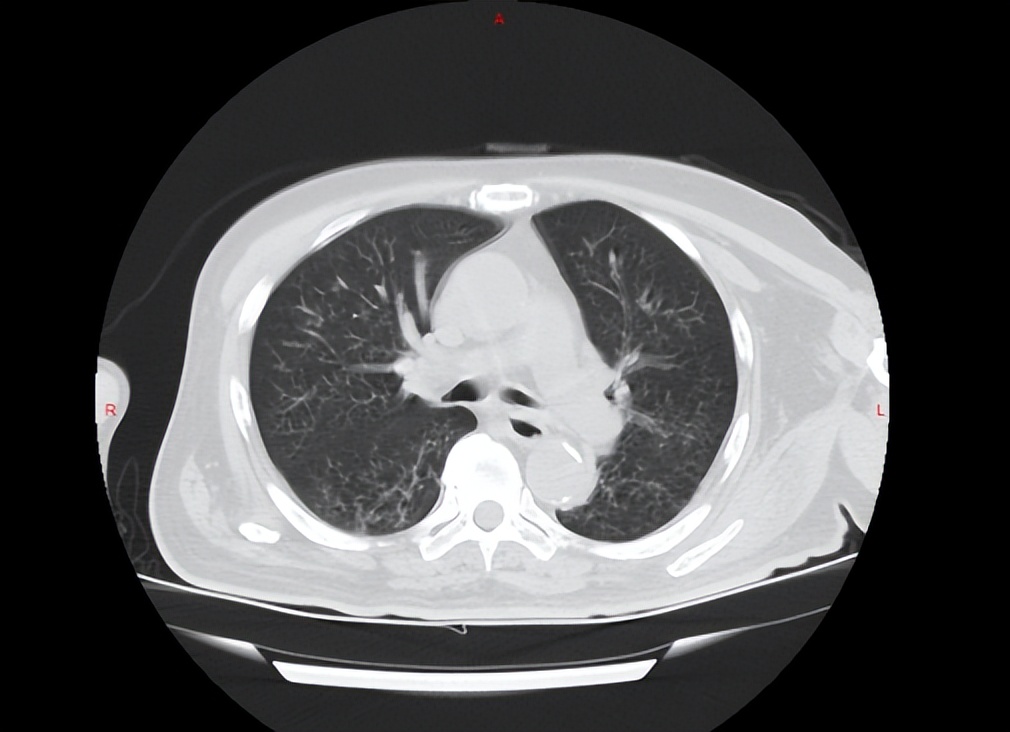 70岁老大爷医直肠癌晚期,六十多岁老人患肠癌坚持二十多年