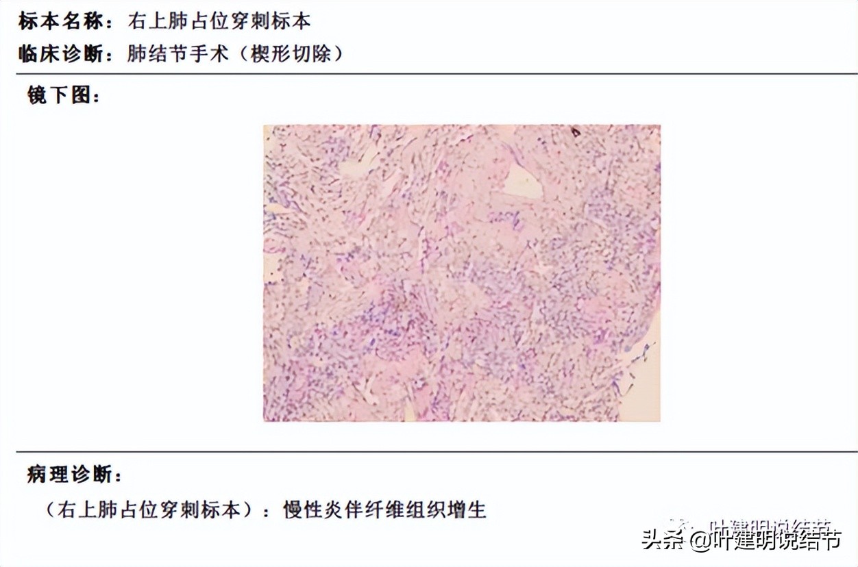 经验：肺占位超6厘米，不是癌还会是什么？临床上仍得多个心眼