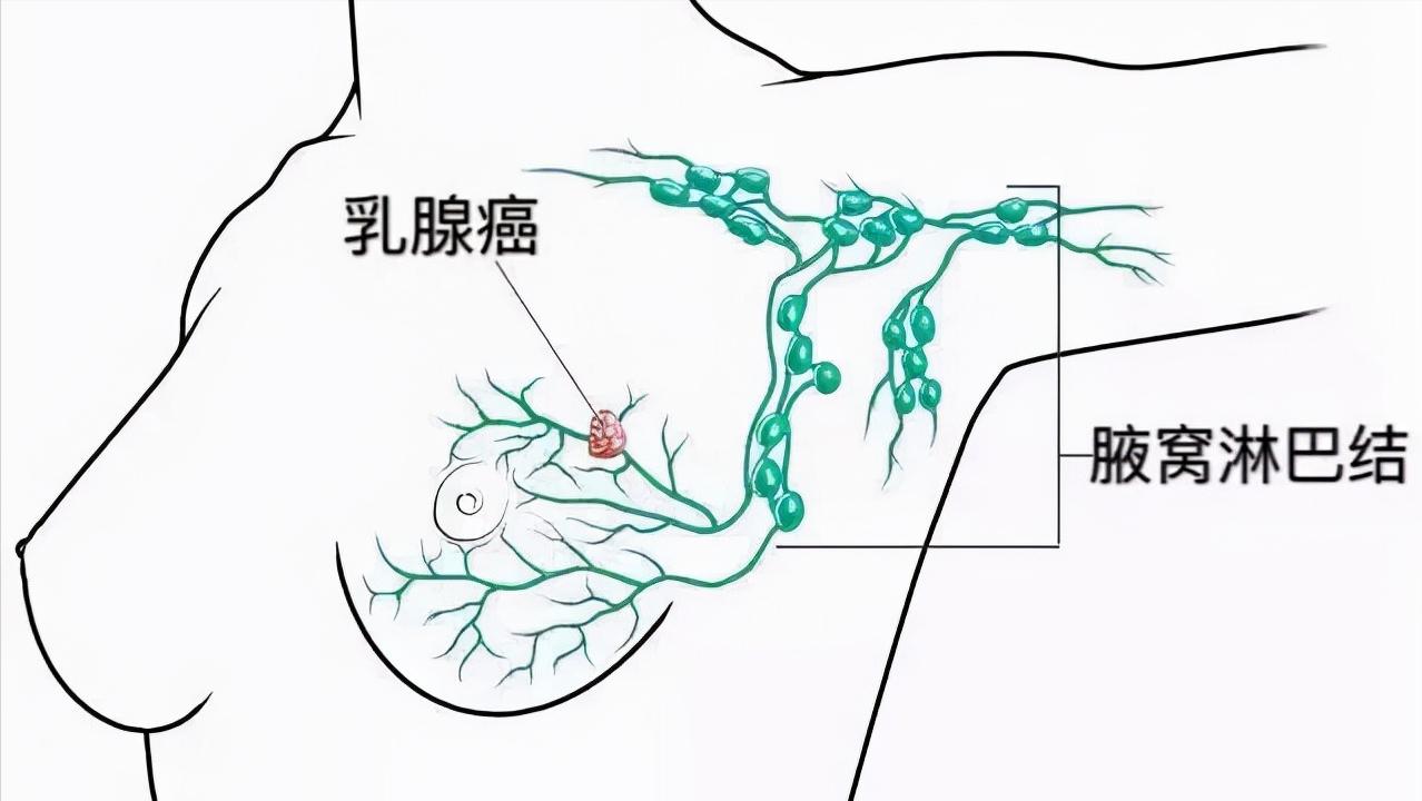 乳腺癌患者手术后，出现上肢水肿，是癌细胞扩散？听听医生怎么说