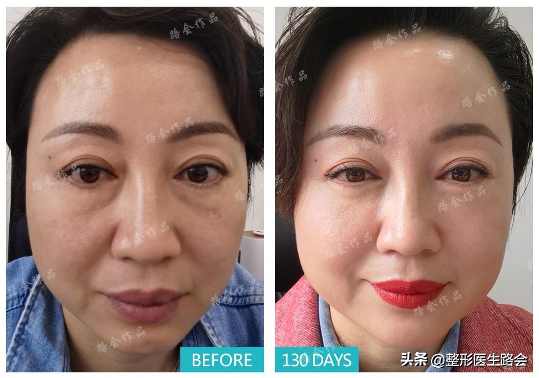 眼袋和卧蚕的区别看完你就知,怎么分清眼袋和卧蚕的区别图片