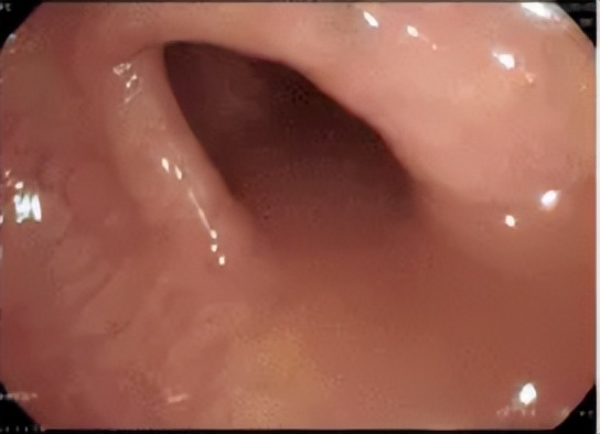 肠道准备不满意影响视野,肠道准备不充分肠镜会漏诊吗