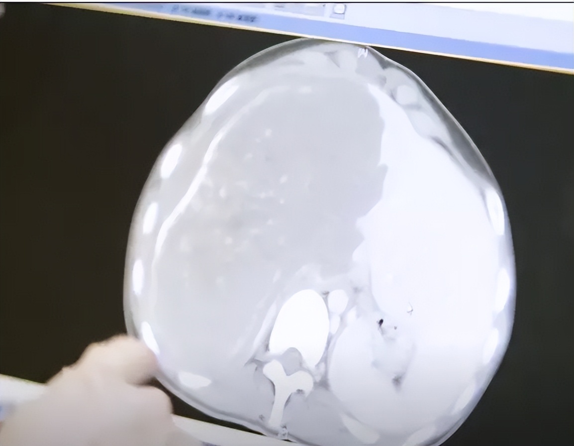 20岁女孩患虫癌死亡,少女患虫癌