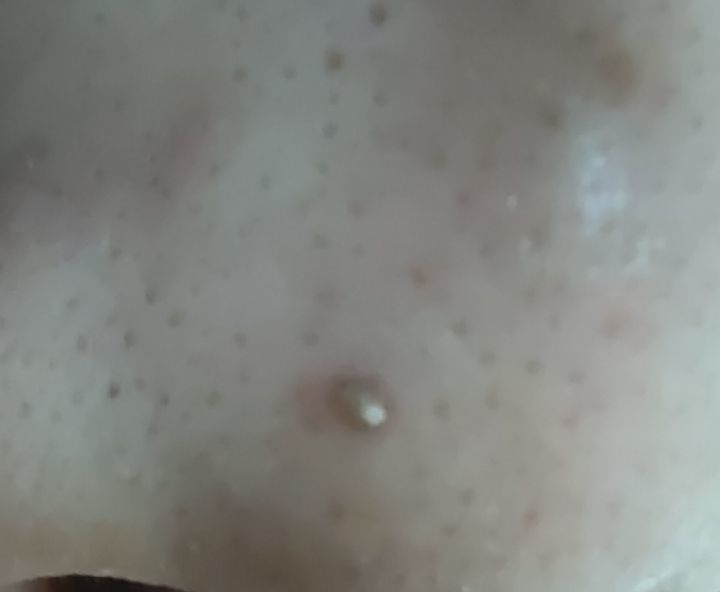 20年的黑头有多大,世界上最长的黑头到底有多长