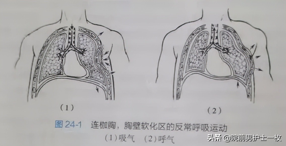 多发肋骨骨折什么意思,多发肋骨骨折怎么治疗