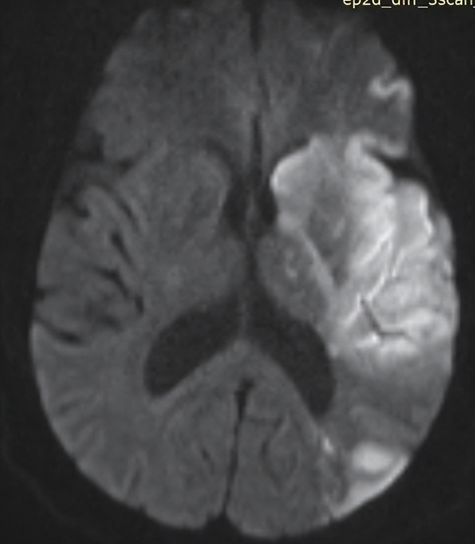 脑梗病人早餐食谱大全,脑梗早餐吃什么比较好