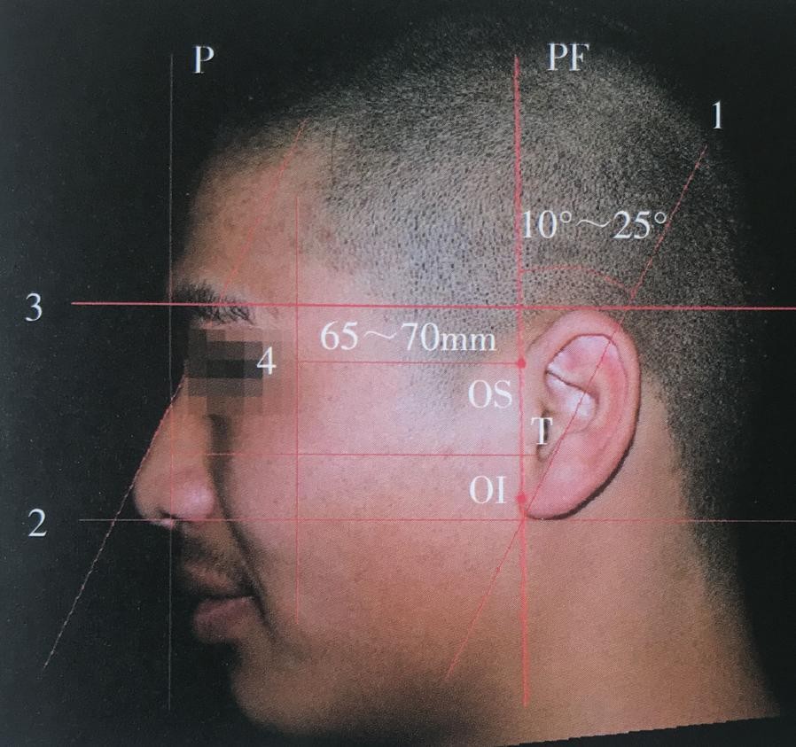 贴耳朵显脸大,贴发耳会改变脸型么