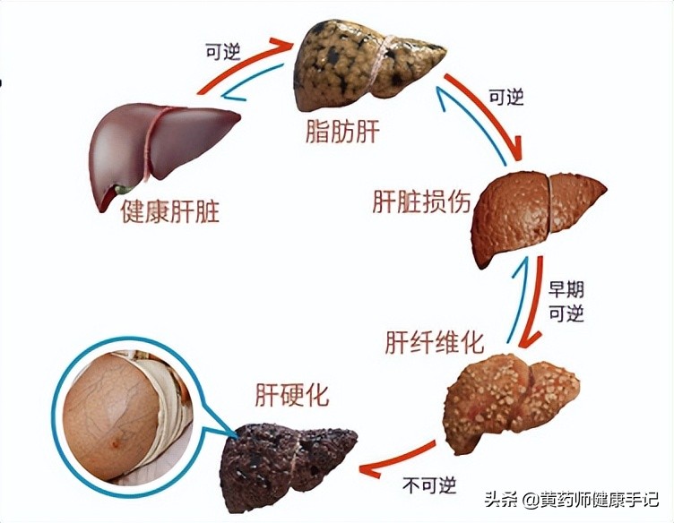 脂肪肝性肝炎吃什么中成药,治疗脂肪肝降转氨酶最好的药