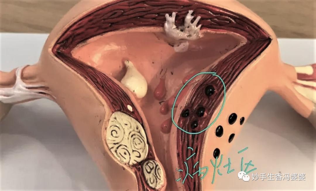 痛经警惕子宫腺肌症,子宫内膜异位症与痛经