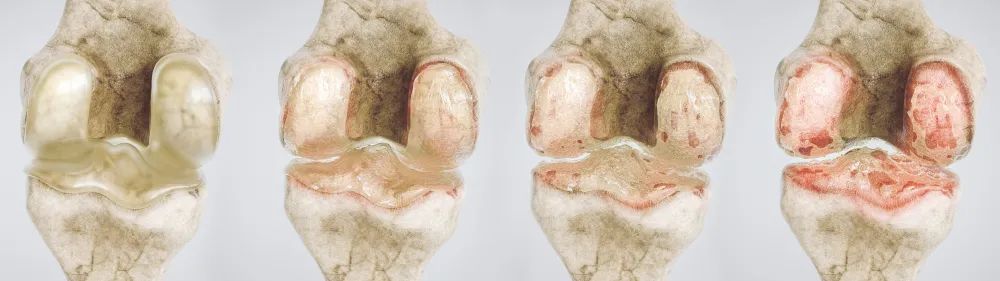 膝关节炎的保健与自我治疗,膝关节炎的保膝治疗