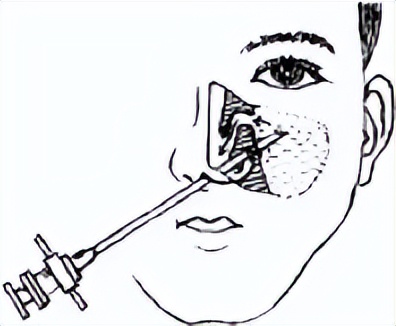 鼻窦炎囊肿穿刺的全过程,鼻窦炎上颌窦穿刺需人陪同