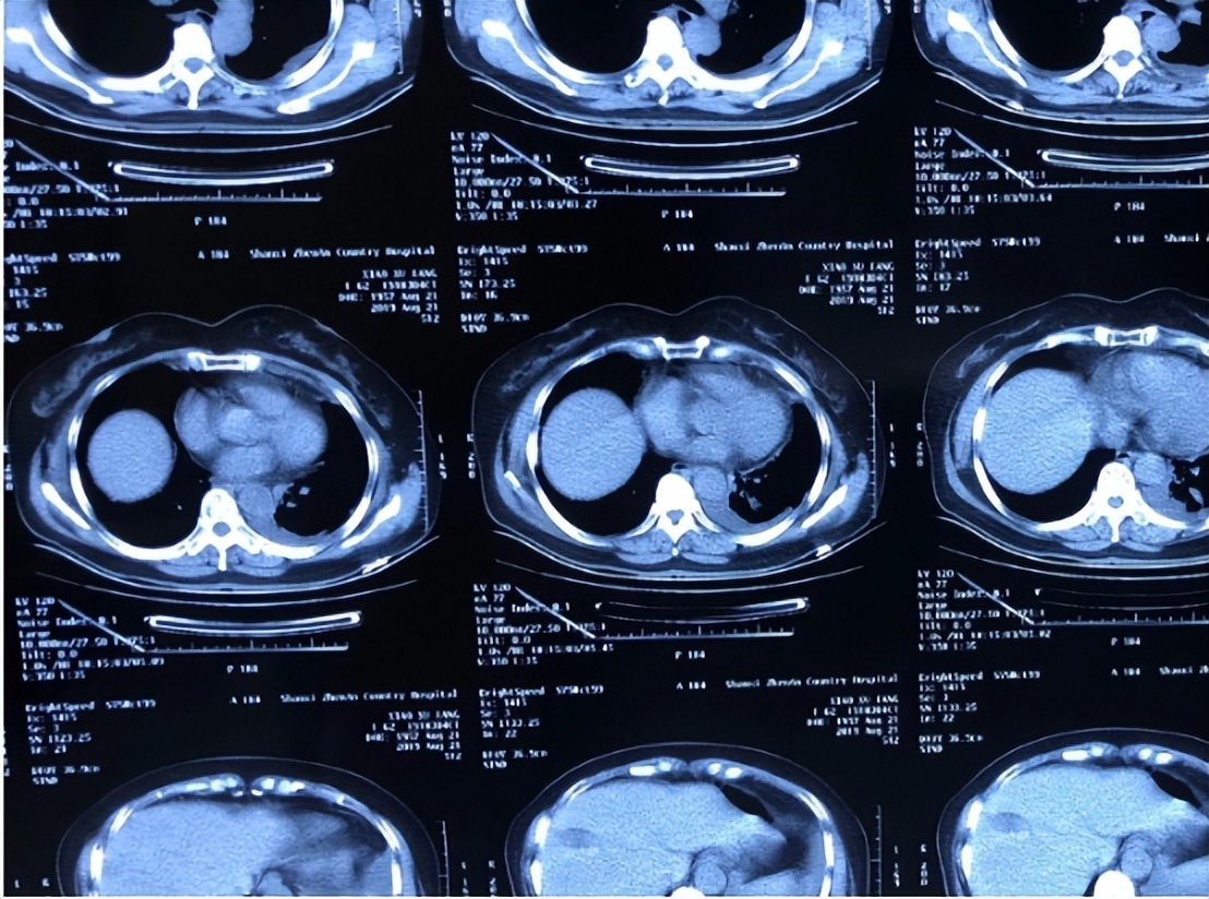 胸腔镜下胸膜冷冻活检，在胸腔积液诊断中，有价值和安全性么