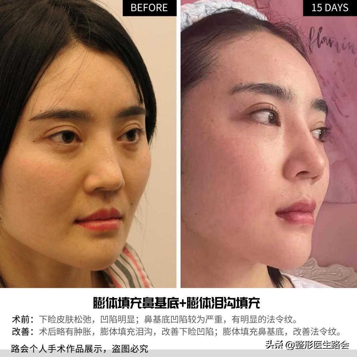 面部暗沉无光泽显老怎么改善,皮肤暗沉皱纹显老