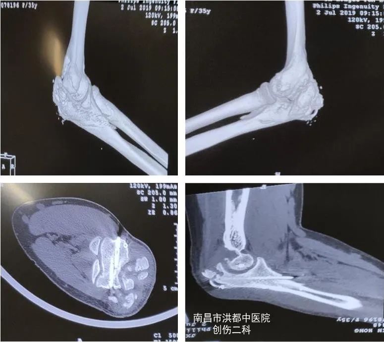 肘关节骨折僵硬康复训练后肿了,肘关节骨折后僵硬的原因