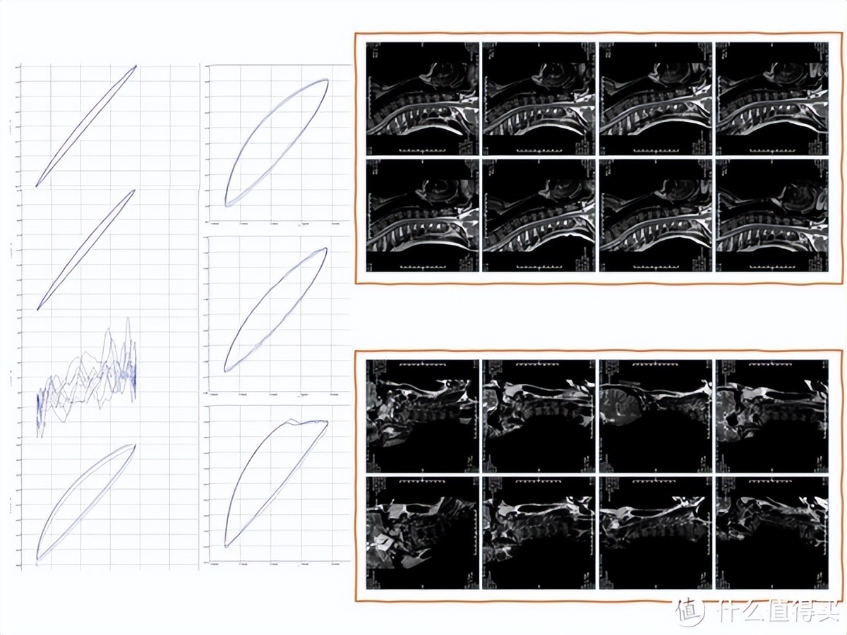 颈椎枕对颈椎病有用吗,记忆枕对颈椎好吗