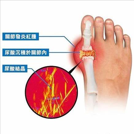 痛风怎样才能彻底把尿酸降下来,痛风止痛且能降尿酸的草药